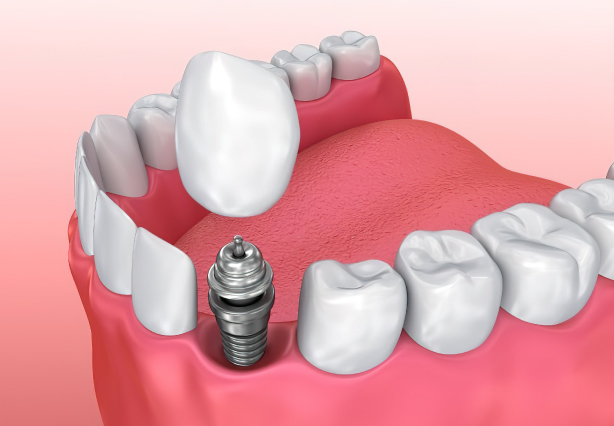 Same Day Implant