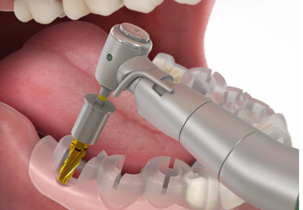 3D Guided Implants