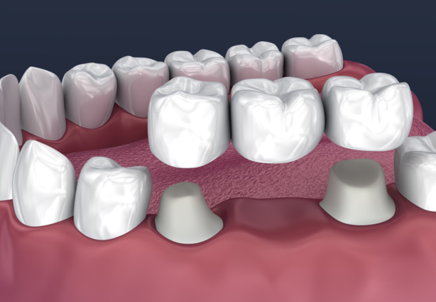 Dental bridges and crowns