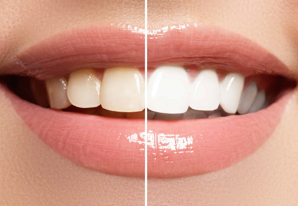 Zoom Teeth Whitening