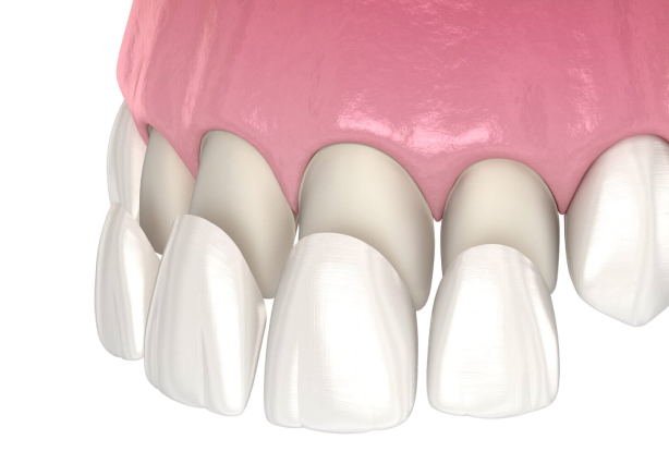 Porcelain Veneers