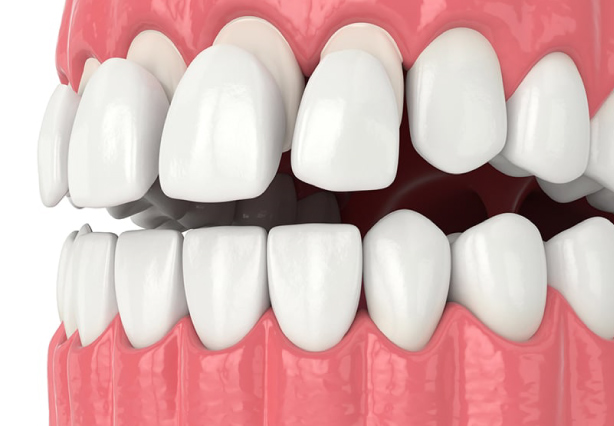 Direct Composite Veneers