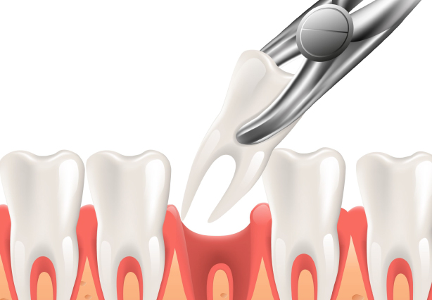 Teeth Extraction