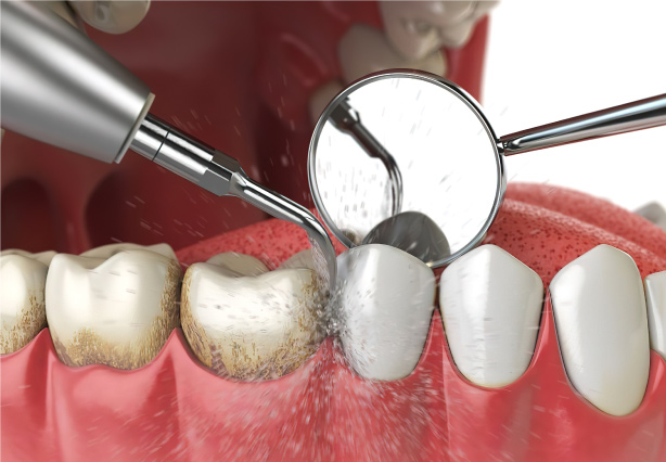 Scaling, Polishing & teeth