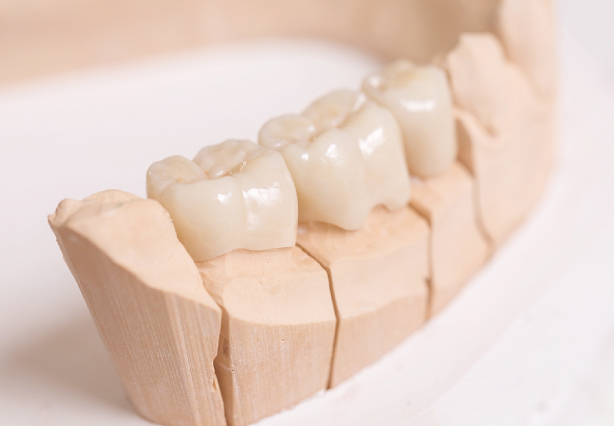 Dental bridges and crowns