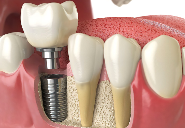 Same Day Implant