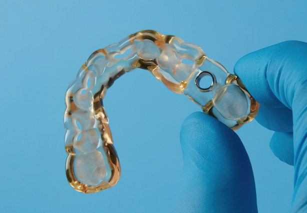 3D Guided Implants