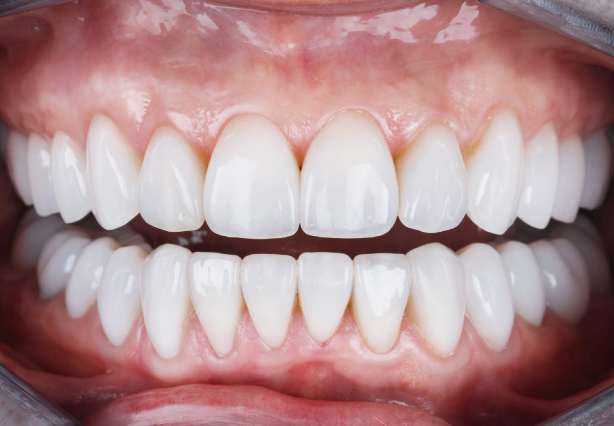 Porcelain Veneers