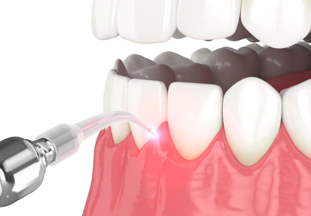 Gum depigmentation