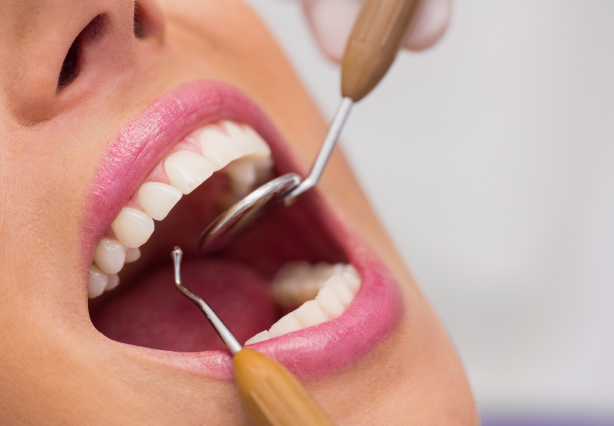 Dental Fillings